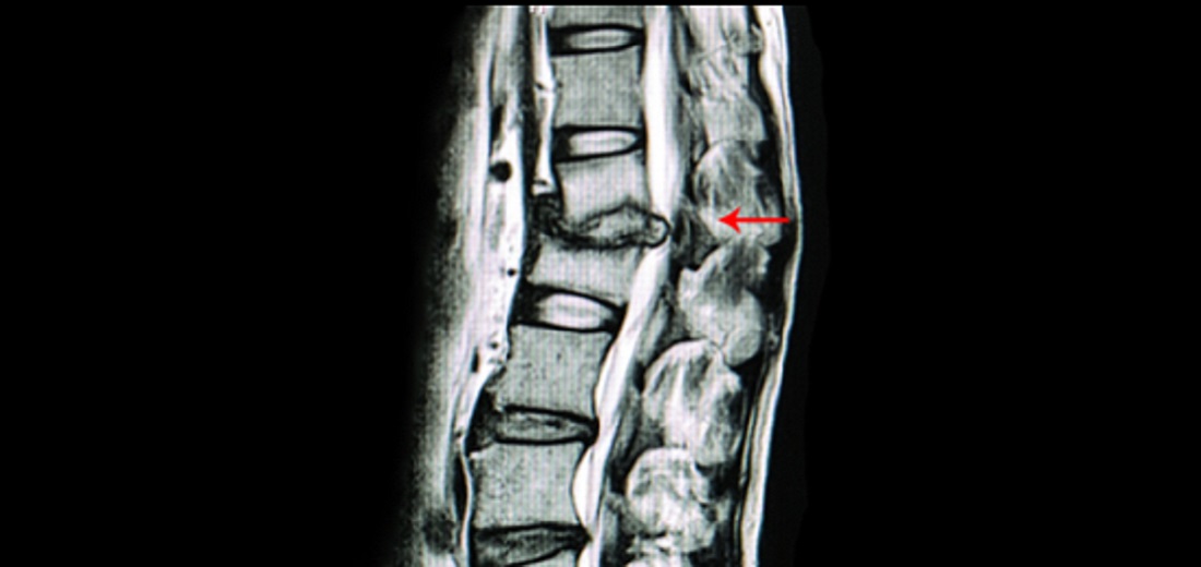 spine-surgery-treatment-bangalore