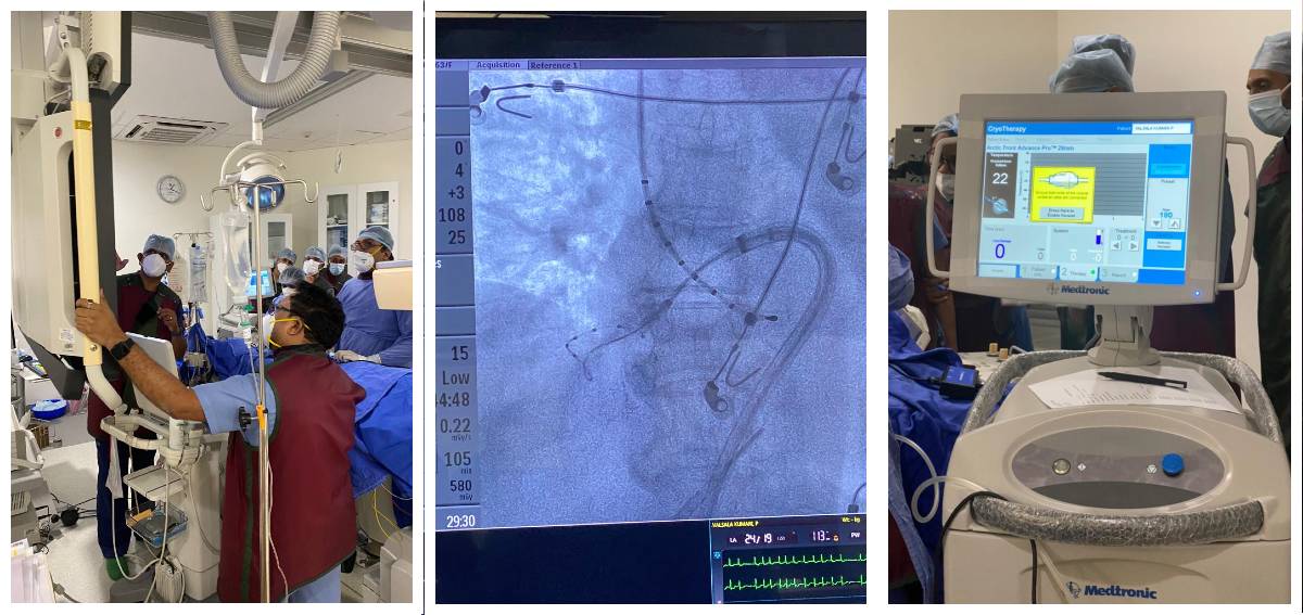 Crayoablation ENG Minimal invasive heart surgery Aster Medcity Kochi