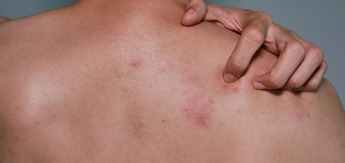 Shingles: Causes, Symptoms, and Treatment
