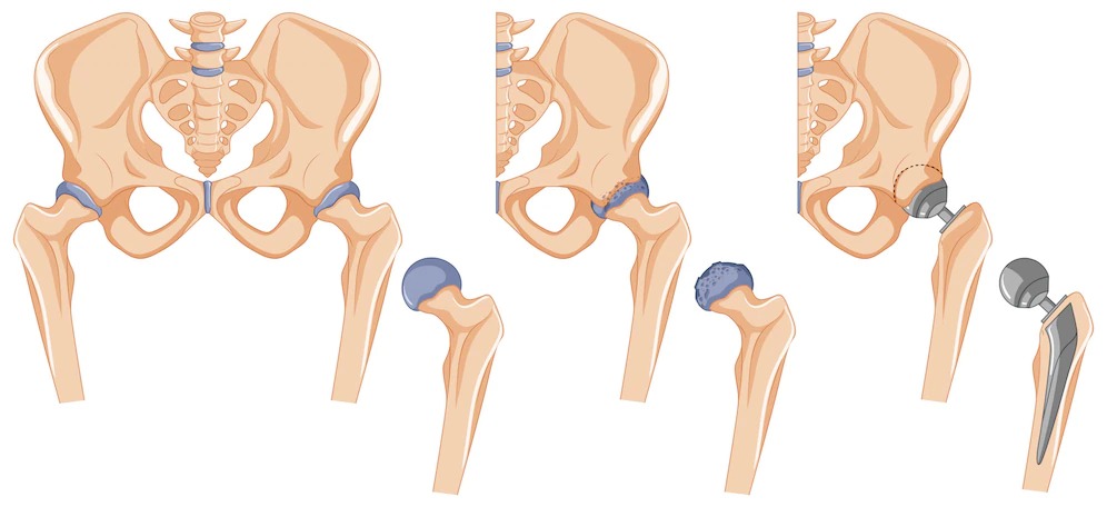 Neglected hip dislocation in Adult-Rare Case