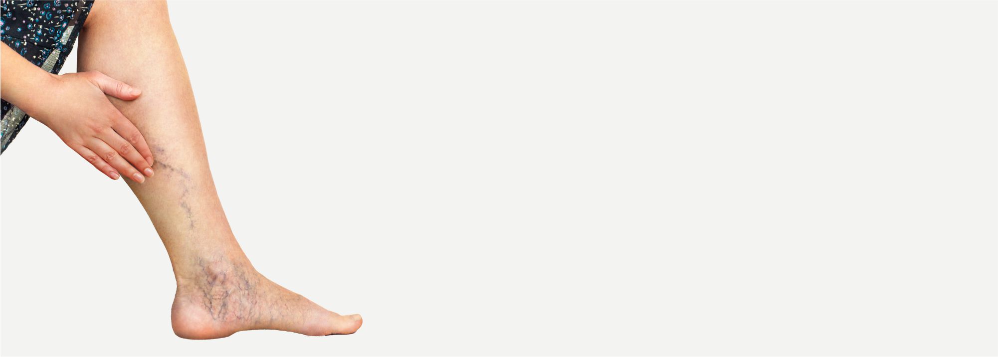 Varicose veins