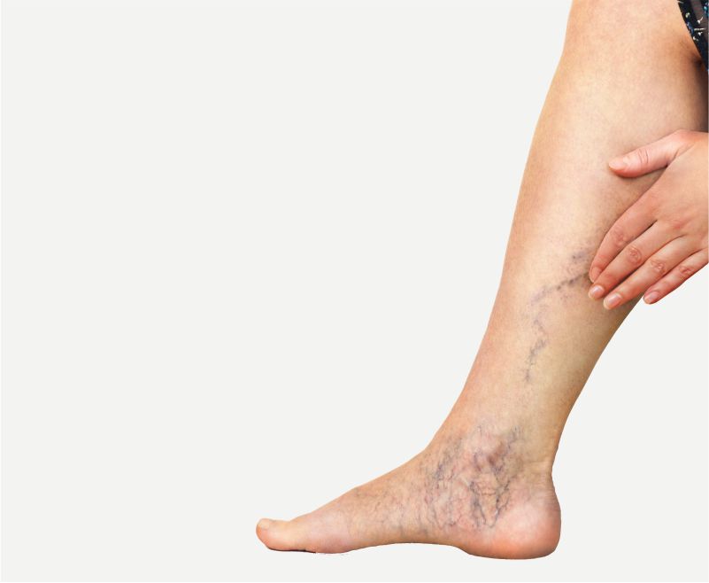 Varicose veins