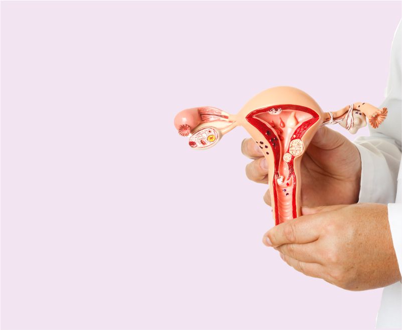 Fibroid