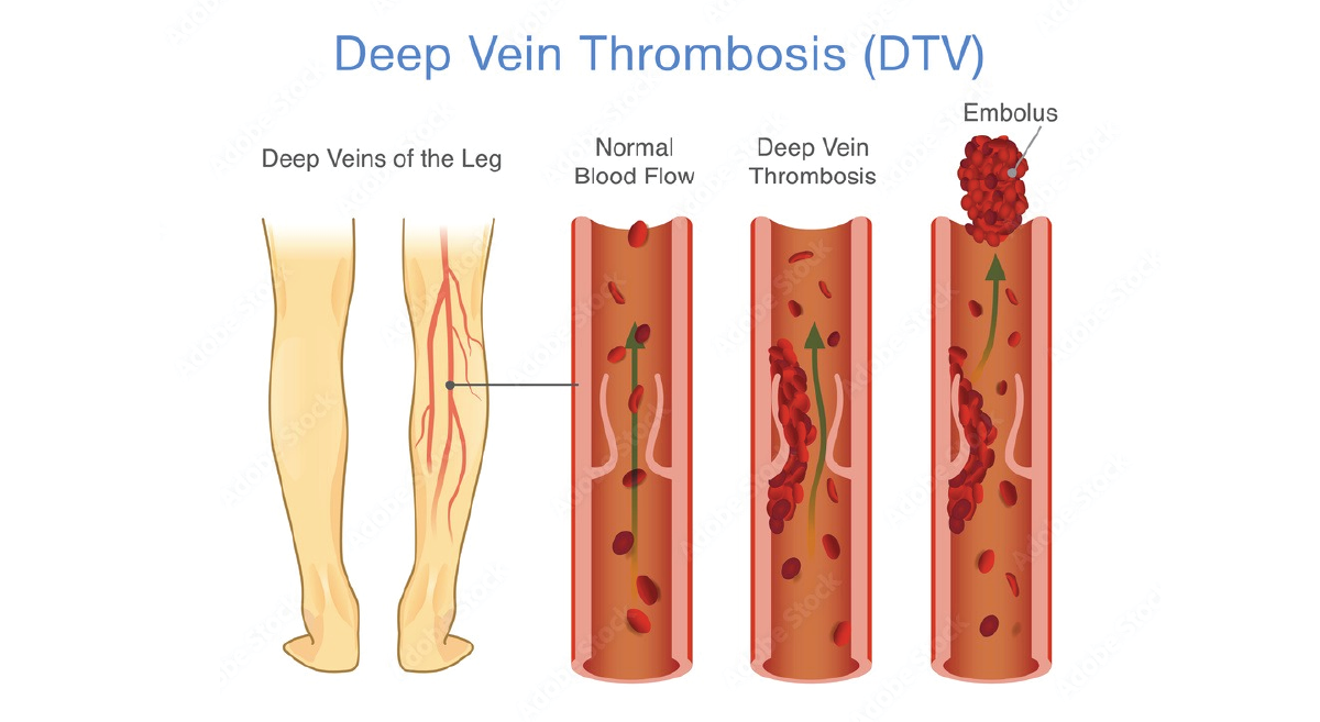 DVT
