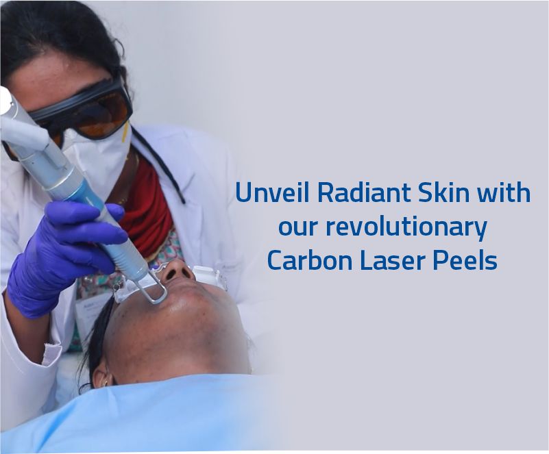 Carbon laser peel