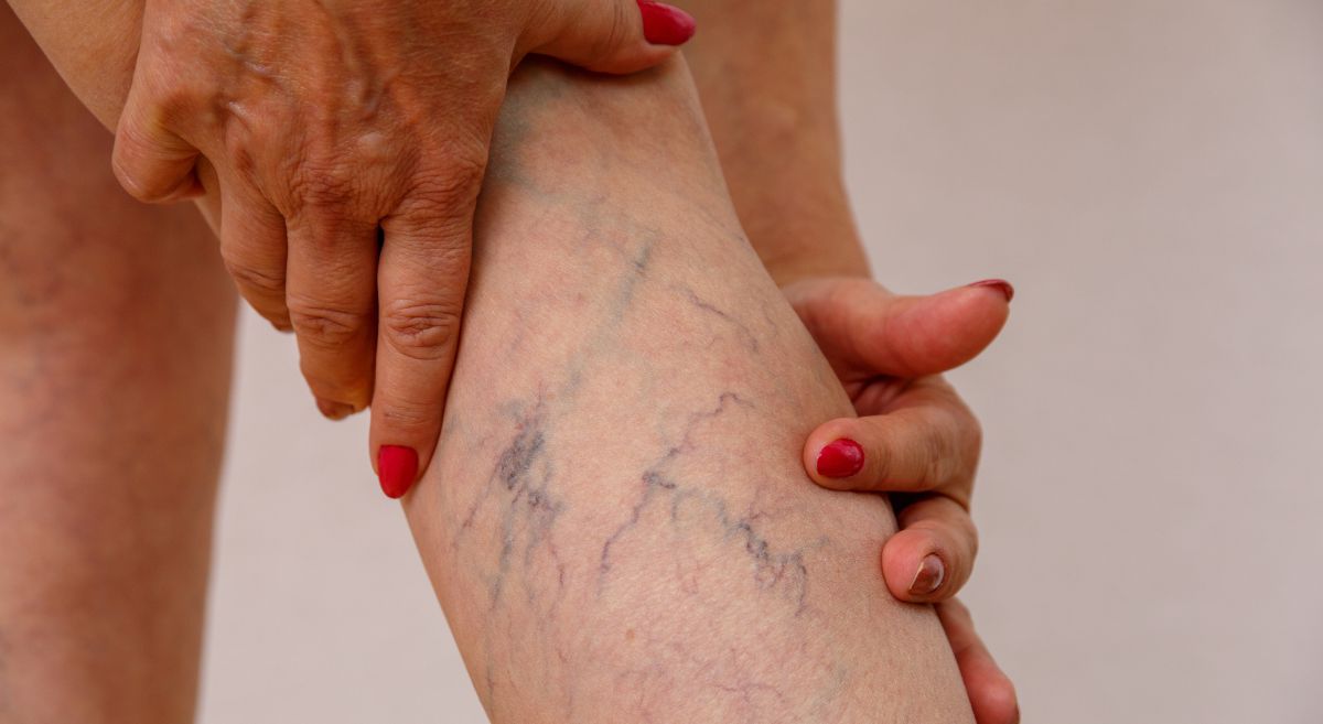 Minimally Invasive Treatment for Varicose Vein