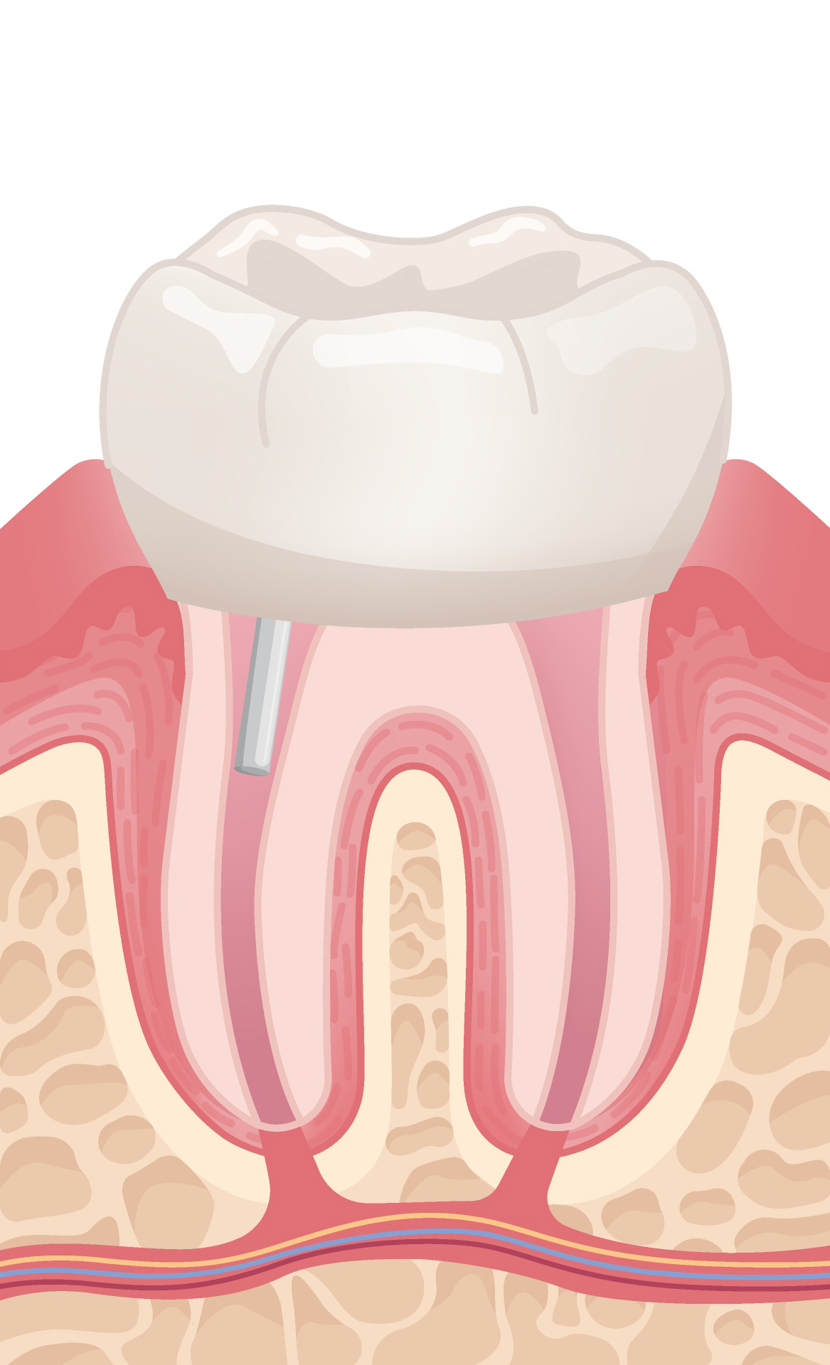 Post Root Canal Treatment.jpg