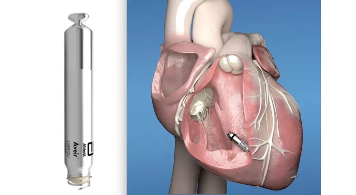 How Leadless Pacemakers Are a Technological Marvel in Cardiac Sciences