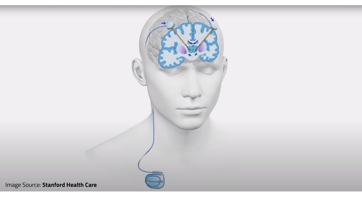 What is Deep Brain Stimulation (DBS) and its Association with Parkinson’s Disease?