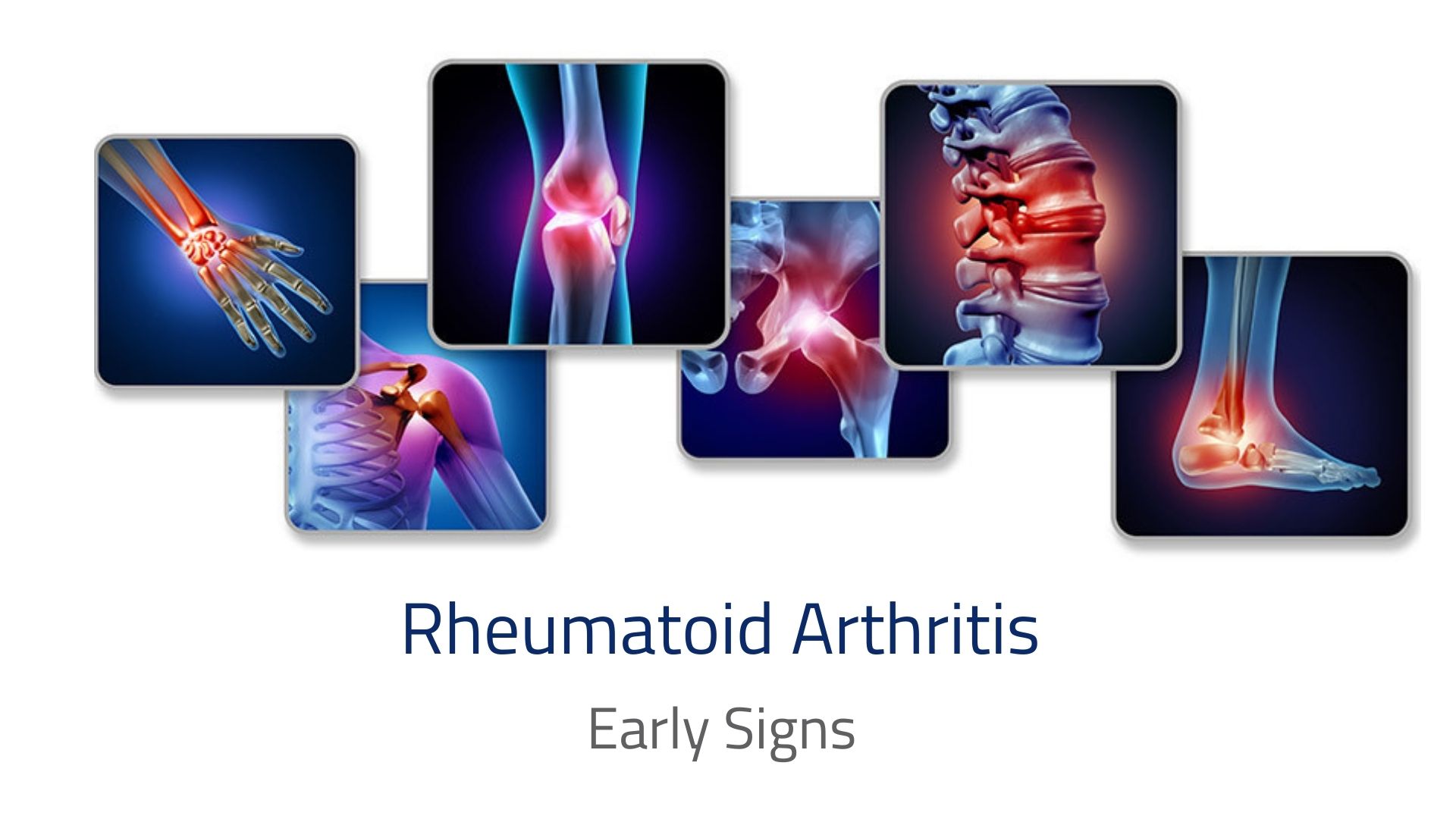 Early Signs of Rheumatoid Arthritis