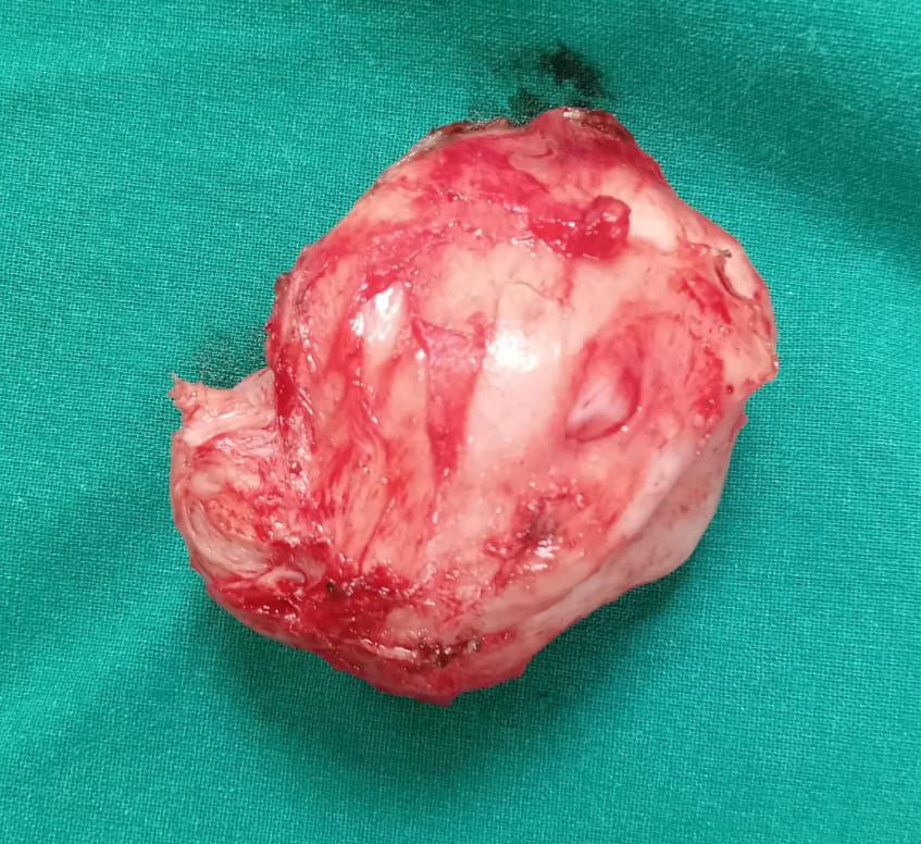 Caesarean myomectomy