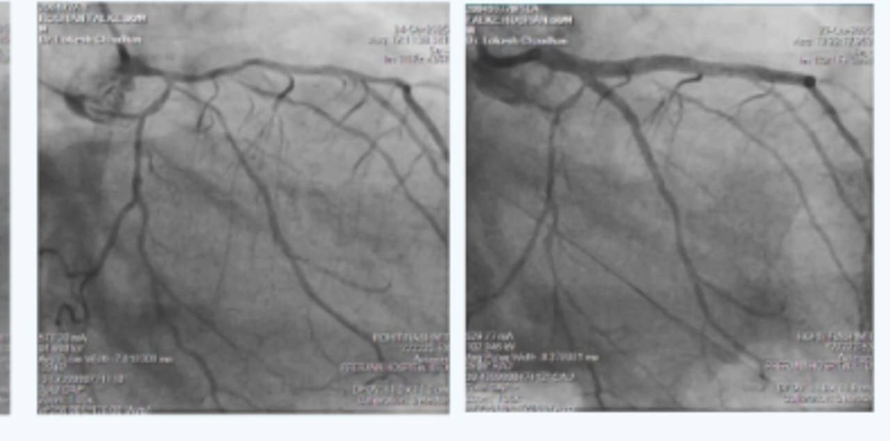 Acute Coronary Syndrome in a Patient with Multiple Comorbidities 1