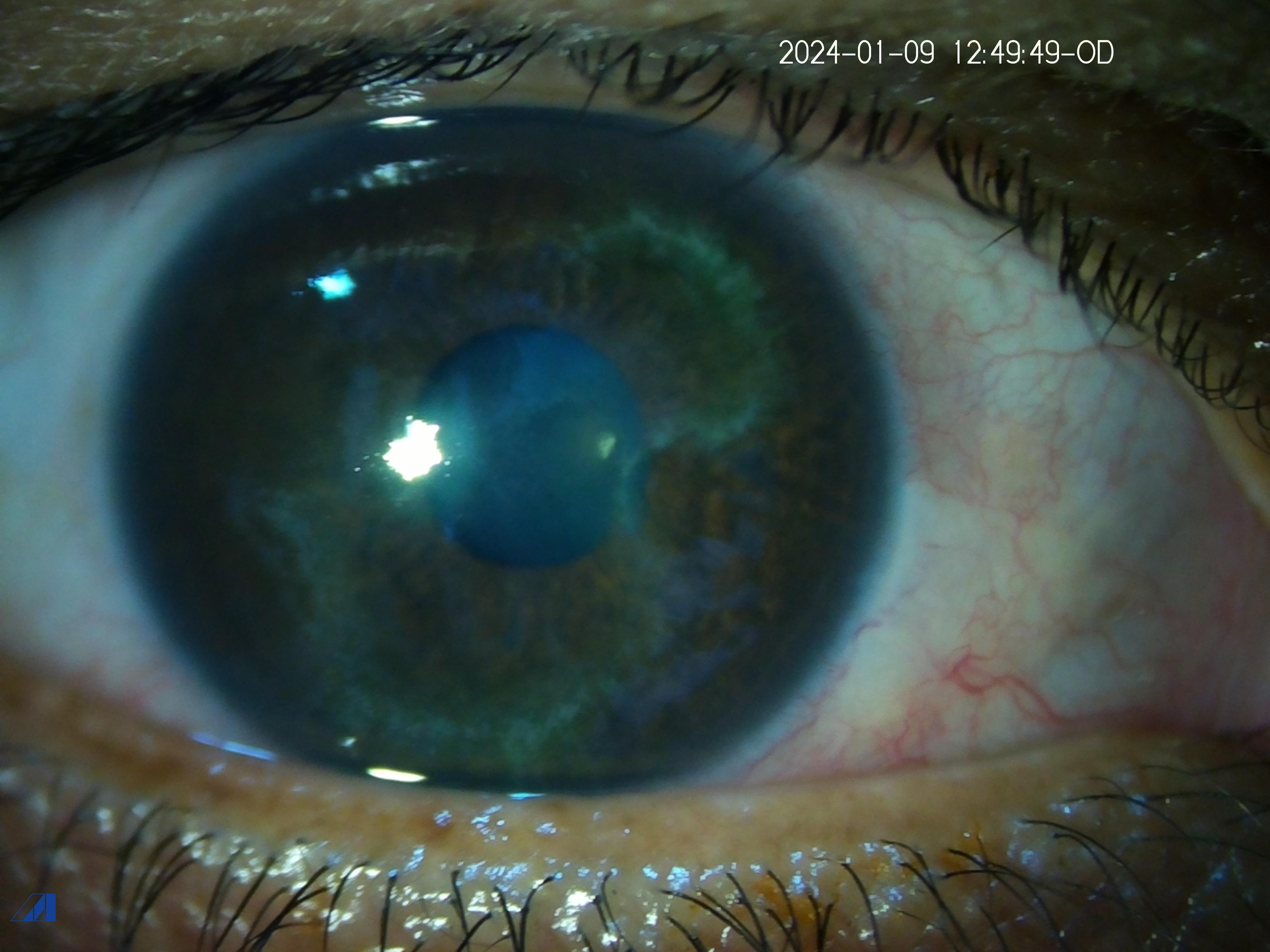 Migratory Corneal 1 st presentation