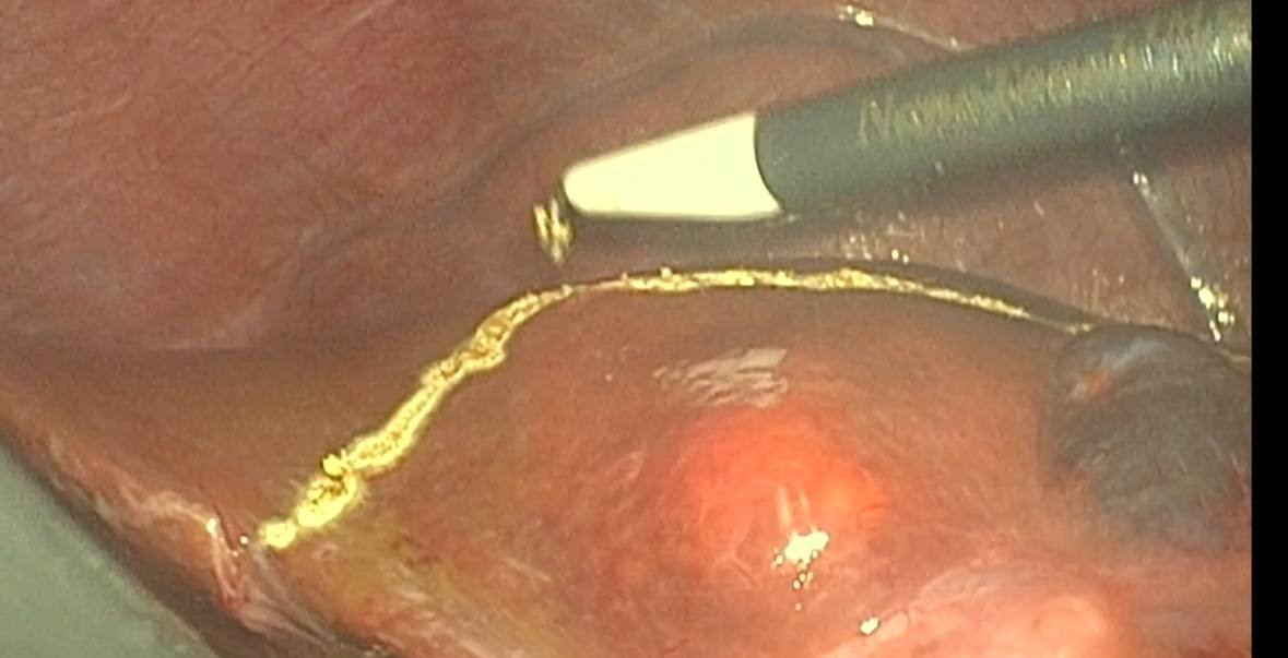 IV Recto-Sigmoid Adenocarcinoma.jpg