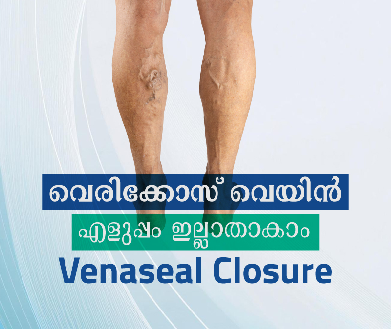 Varicose vein