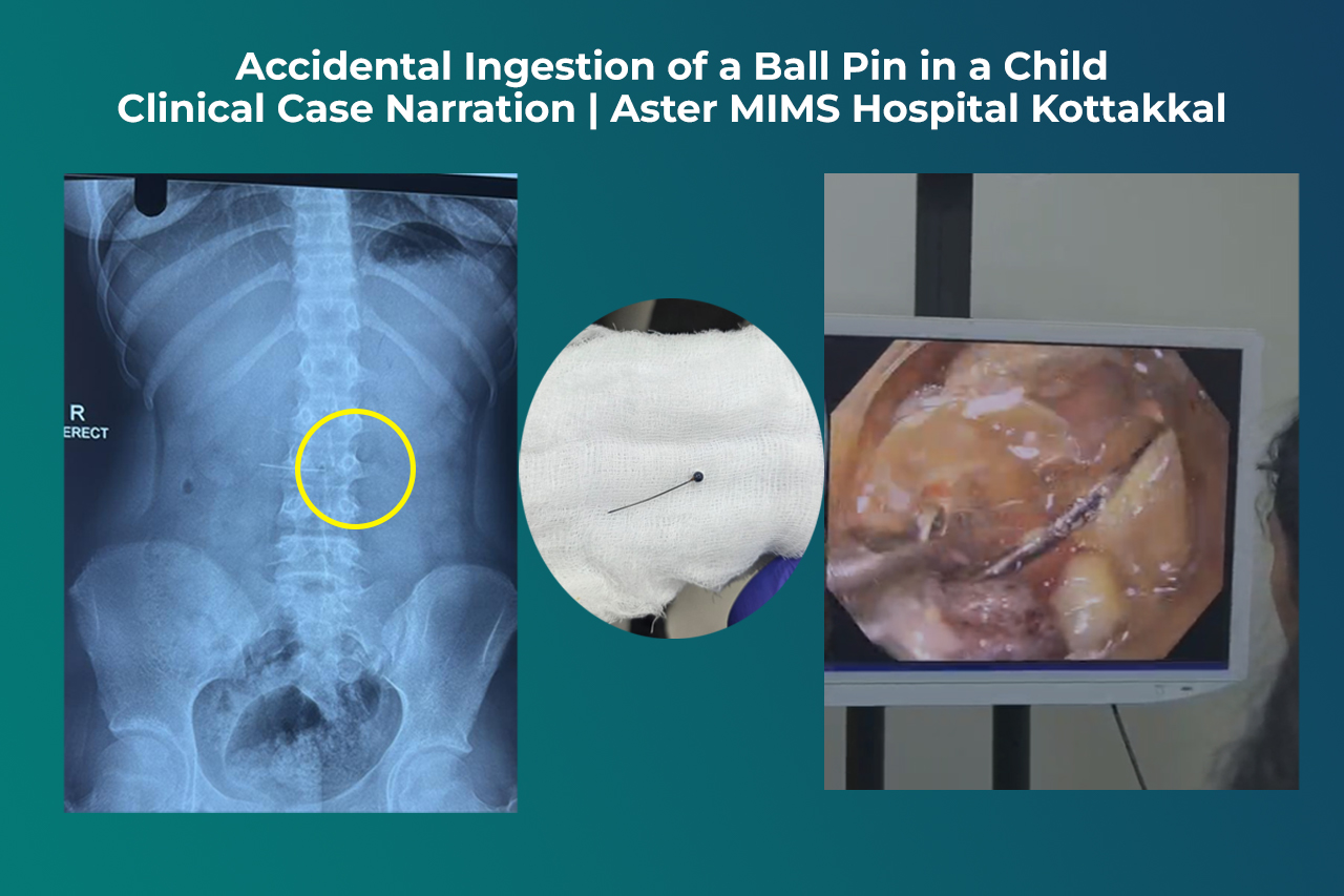 Accidental Ingestion of a Ball Pin in a Child