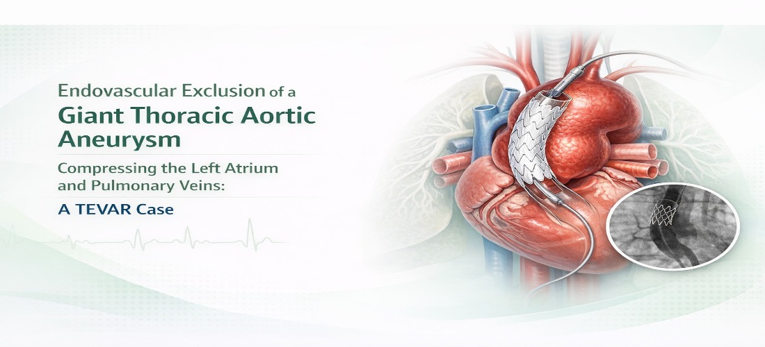 Endovascular Exclusion of a Giant Thoracic Aortic Aneurysm Compressing the Left Atrium and Pulmonary Veins: A TEVAR Case 1
