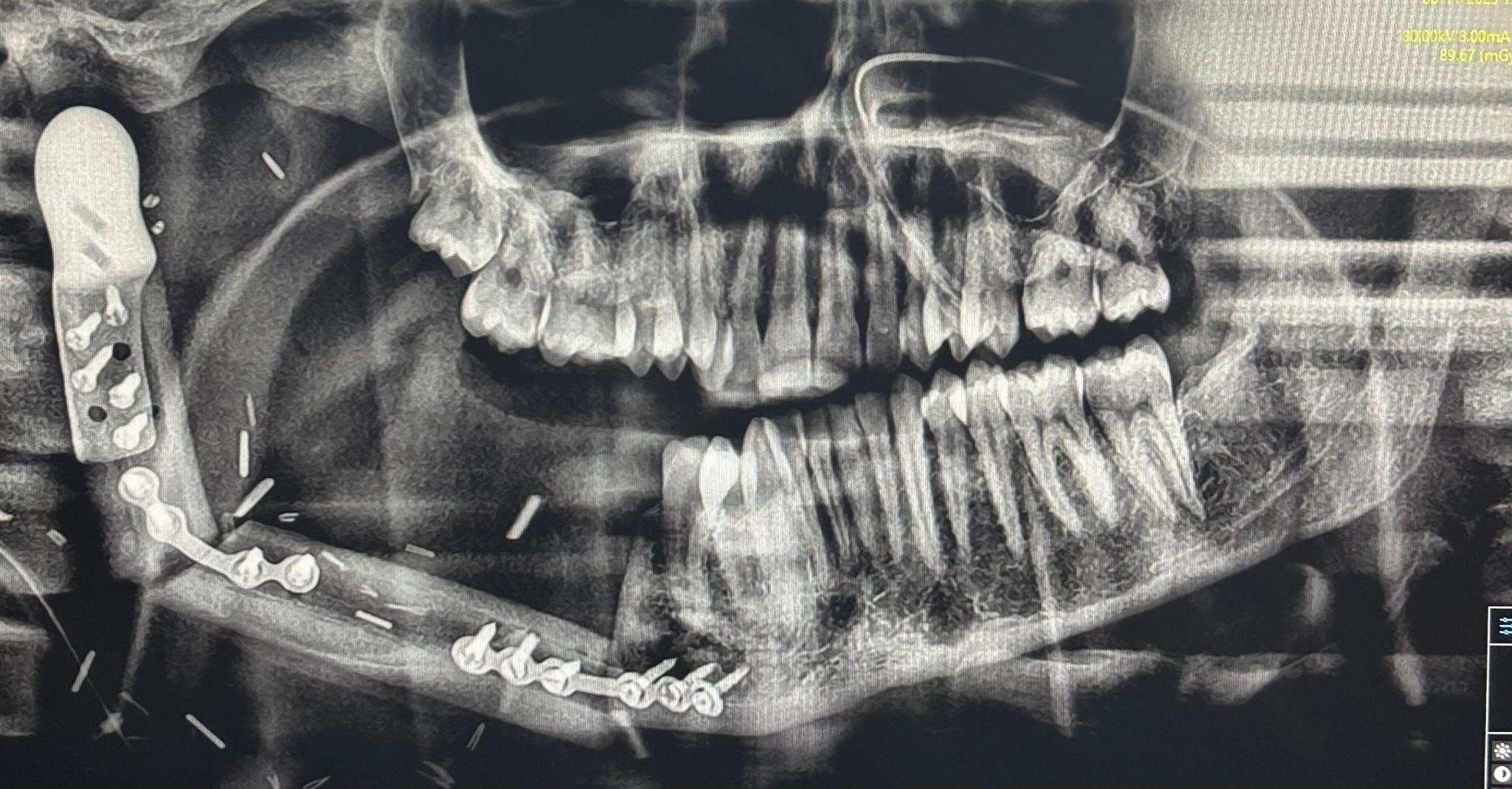 Free fibula flap