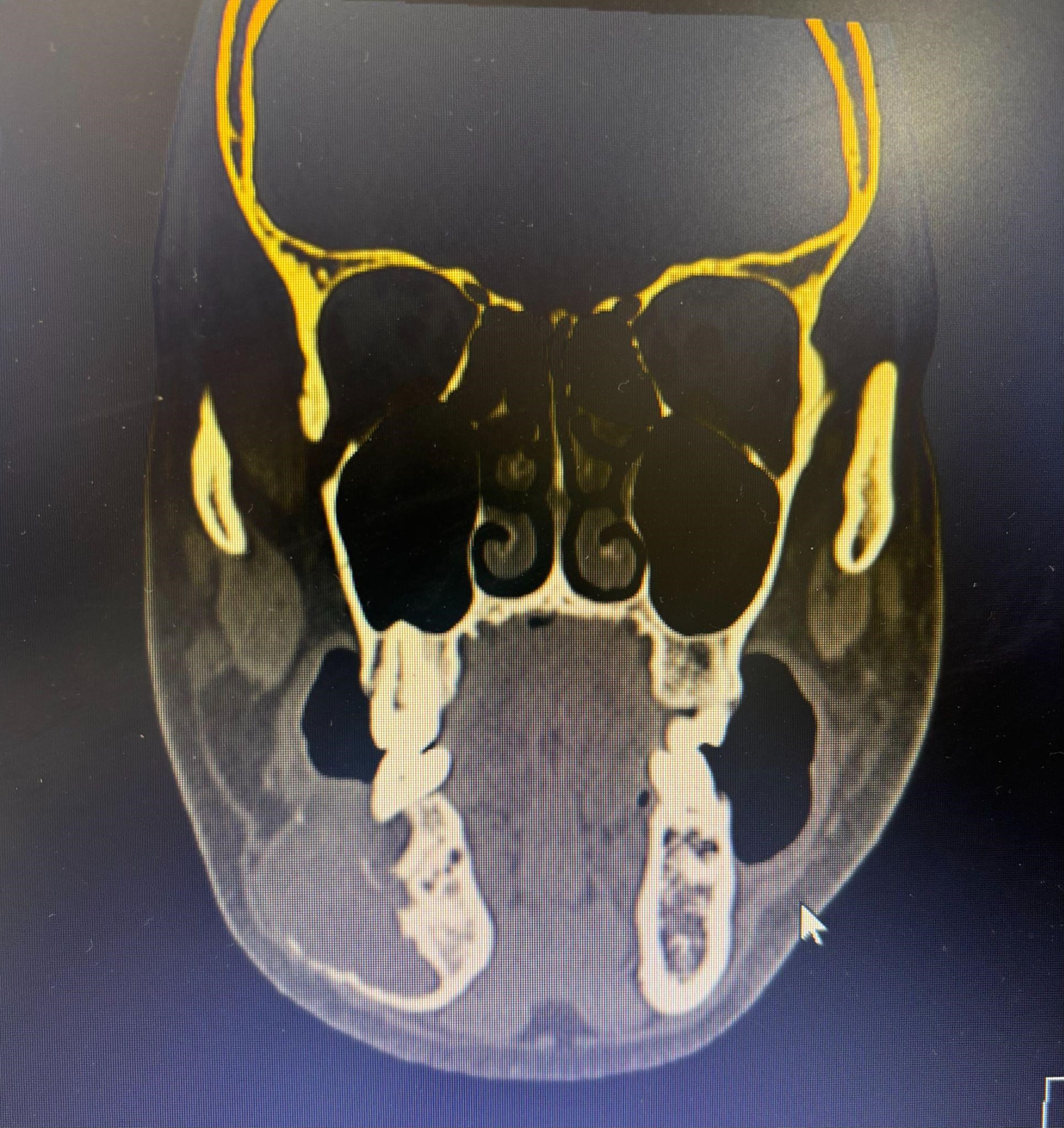 Ameloblastoma 