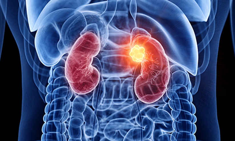 kidney disease 