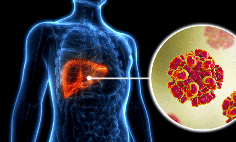 Hepatitis Liver  Disease