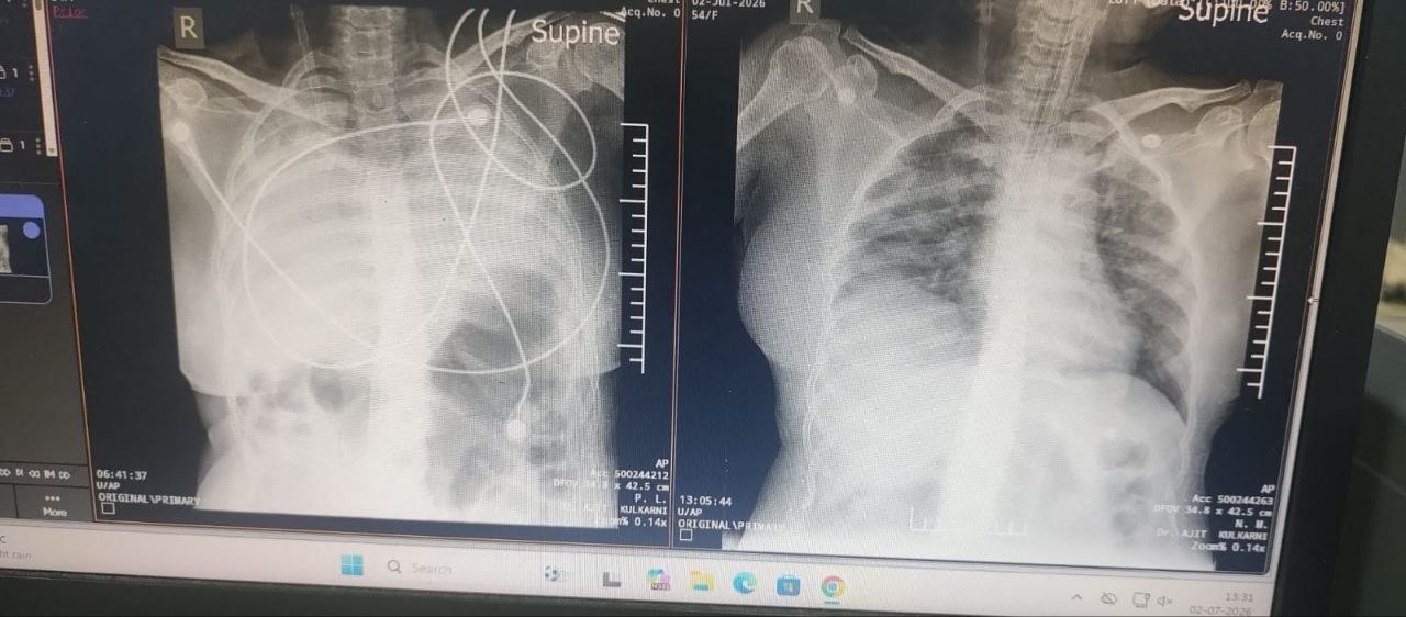 Pre & Post CXr cryo clot retrieval and airway clearnce