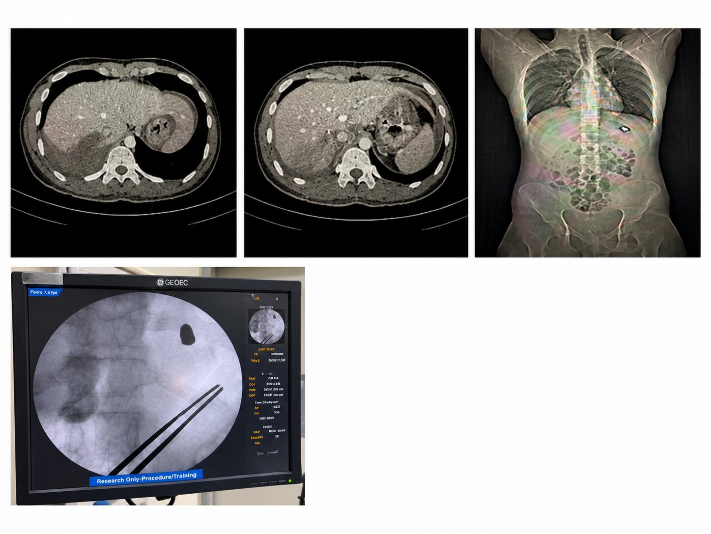 Life-Threatening Chest and Abdominal Gunshot Injury