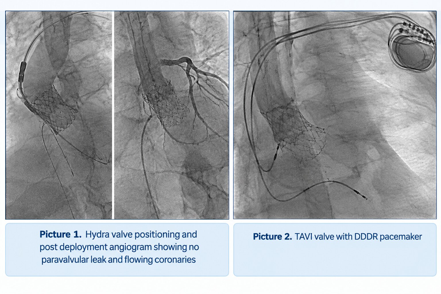 tavi case sept 26