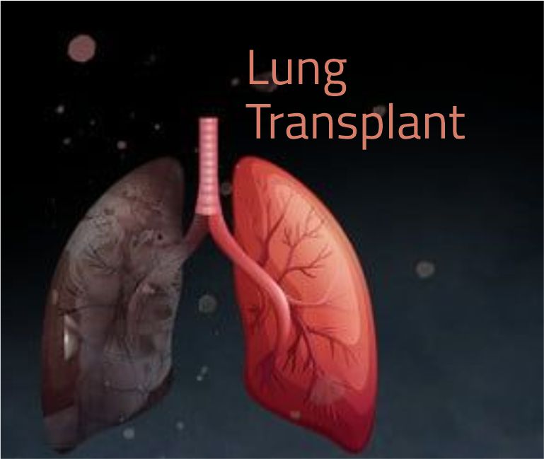 Lung Transplant