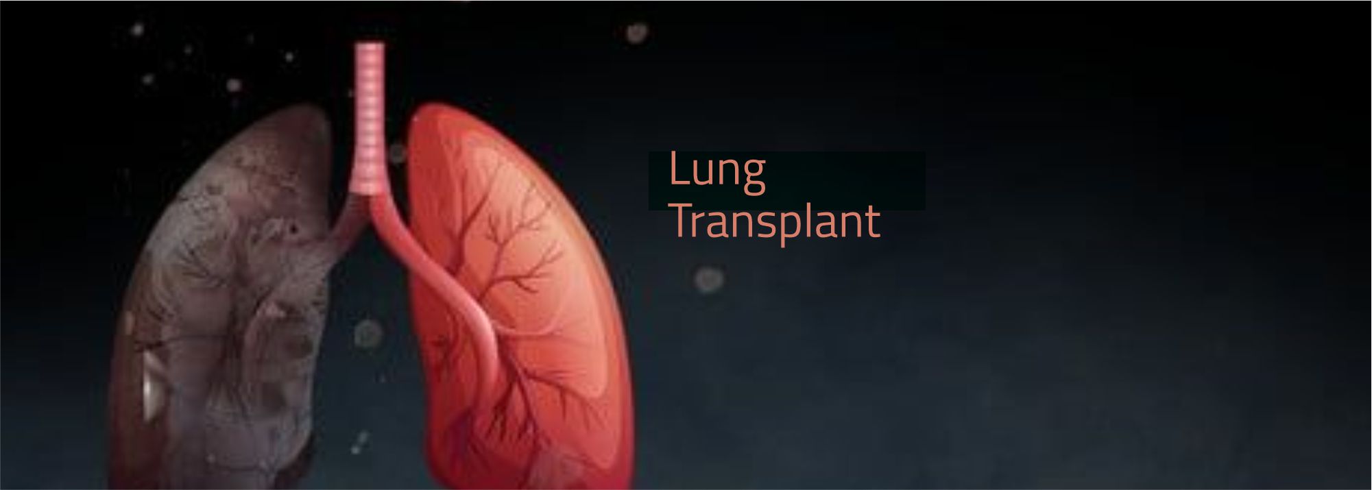 Lung Transplant