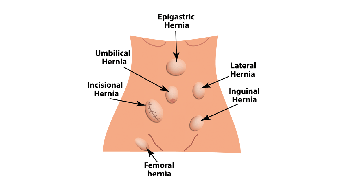 Hernia