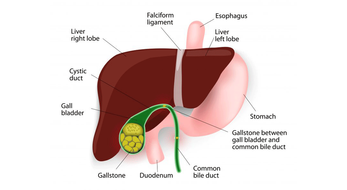 Gall Bladder Stones