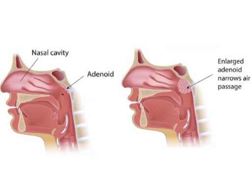 Adenoidectomy