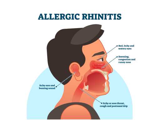 Allergic rhinitis