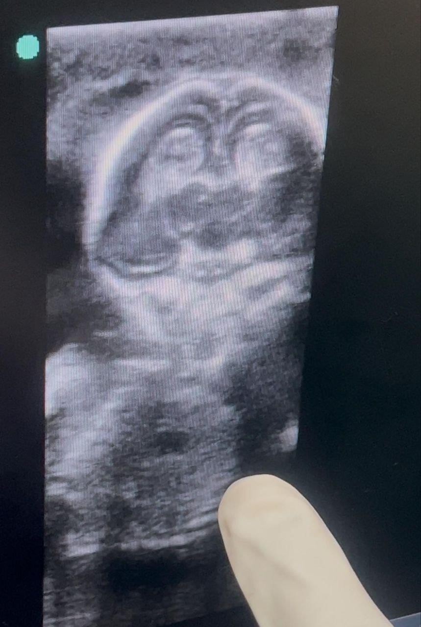 Borderline ovarian tumors 2