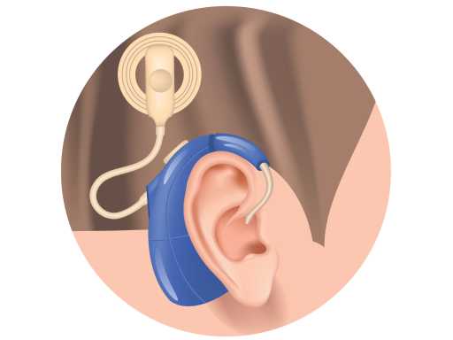 Cochlear Implant