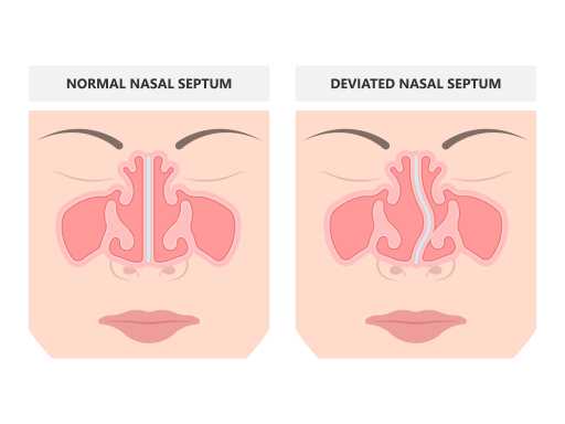 Deviated septum