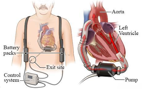 Ventricular Assist Device