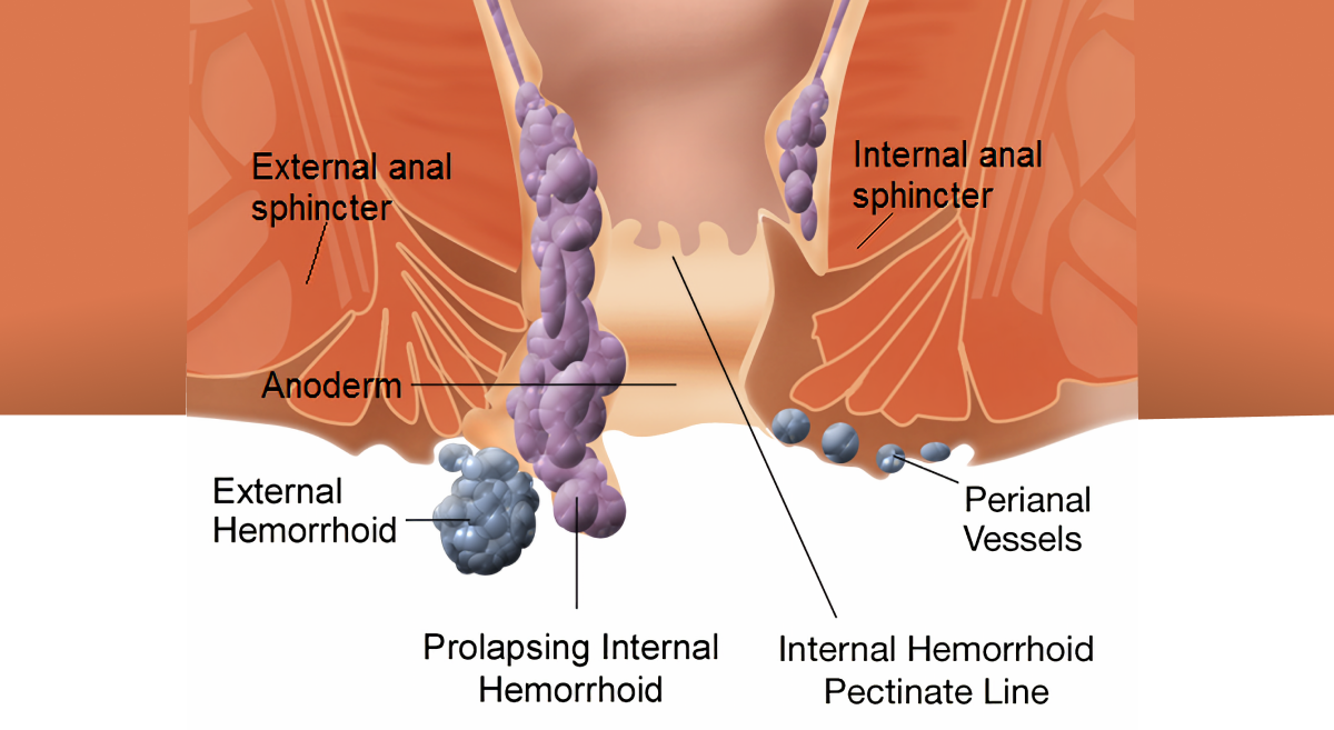 UNDERSTANDING HEMORROIDS