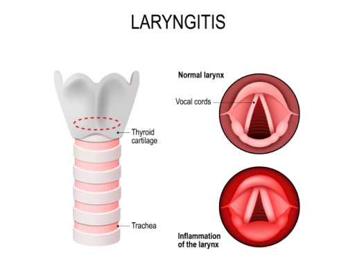 Laryngitis