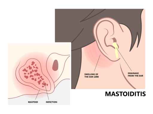 Mastoiditis