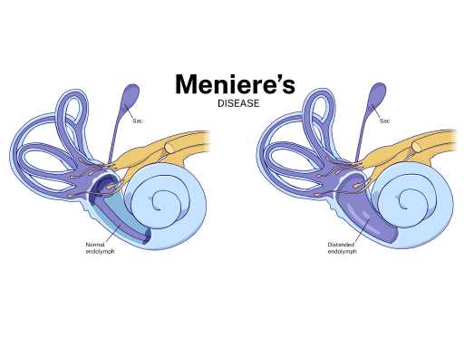 Ménière's disease