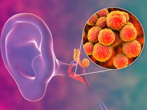 Otitis Media