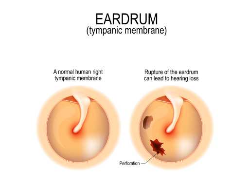Perforated eardrum