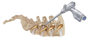 Spine surgery