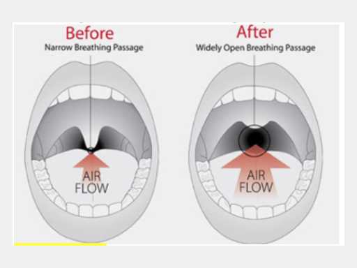 Snoring Correction Surgery