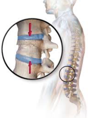 Spine surgery