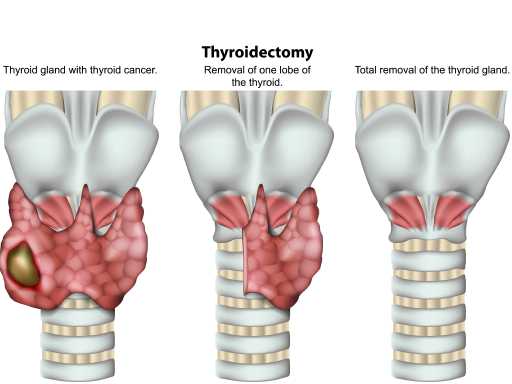 Thyroidoctomy