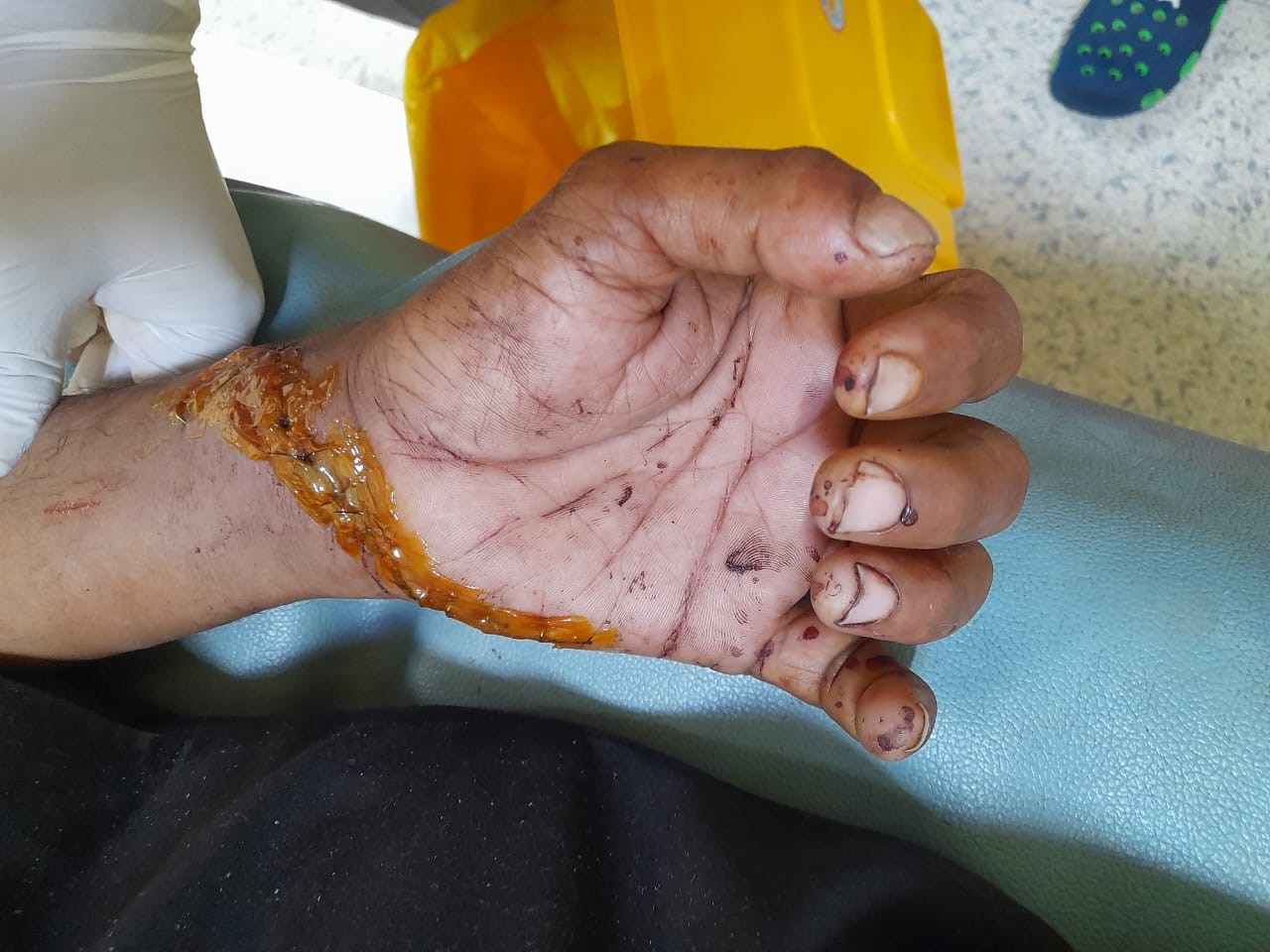 Combined Vascular, Tendon, and Nerve Injury of the Wrist: A Case Report 2