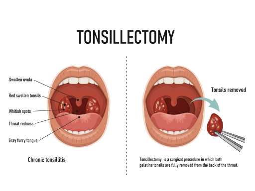 Tonsillectomy